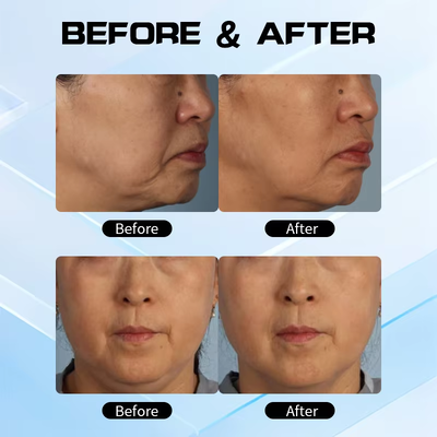 New XERF Dual Frequency RF Skin Tightening Machine 6.78MHz & 2MHz Monopolar RF Anti-Aging Device XERF Machine